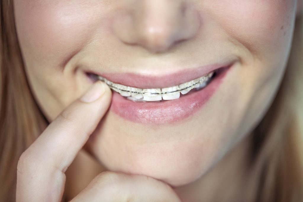 Ceramic Braces