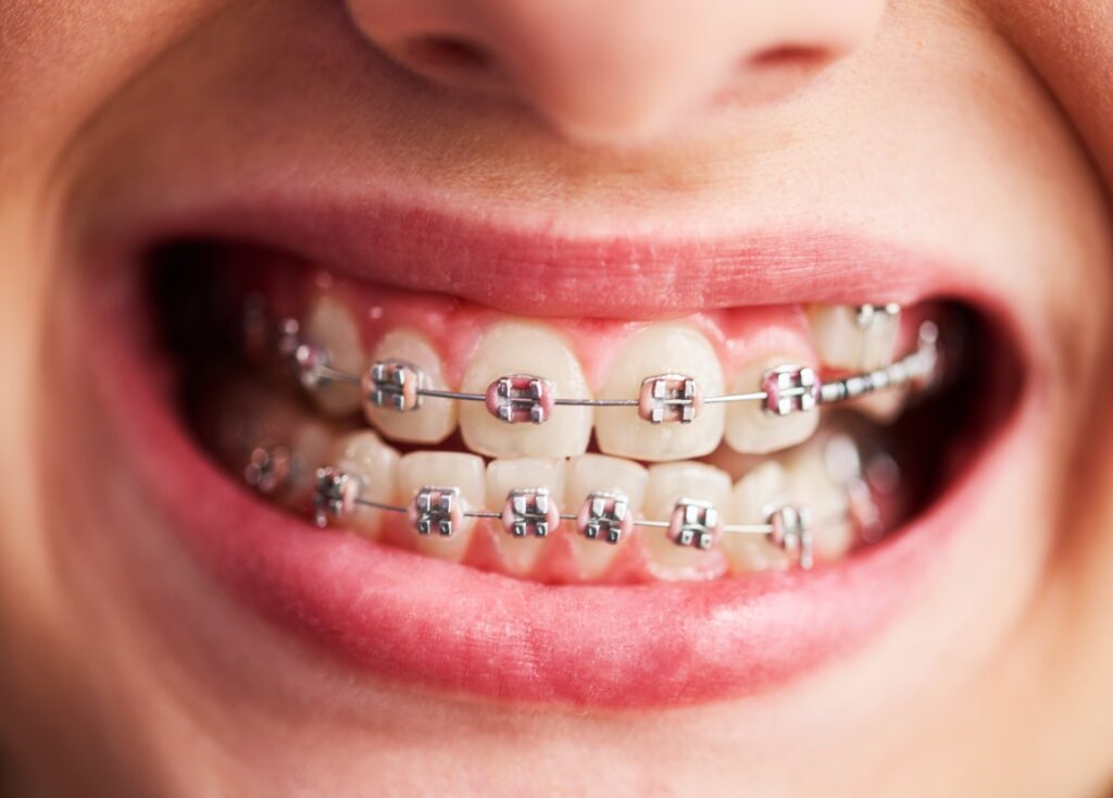 Fake brackets