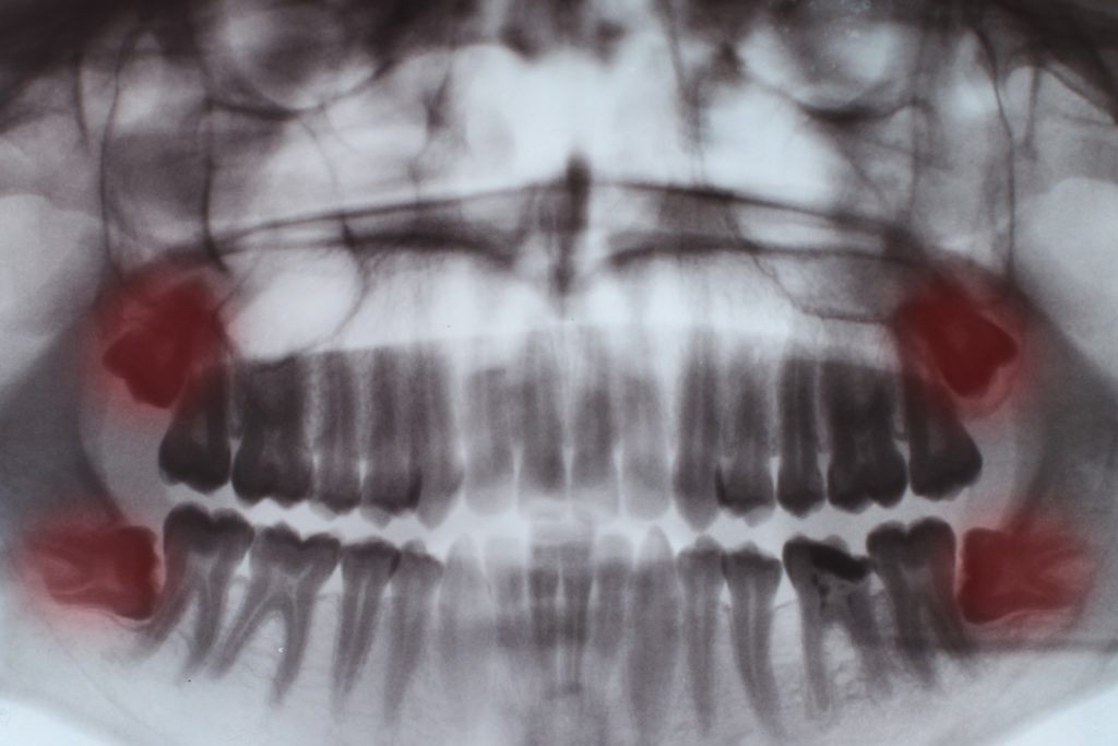 Impacted Wisdom Tooth