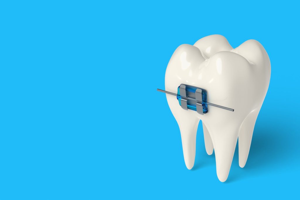 braces types