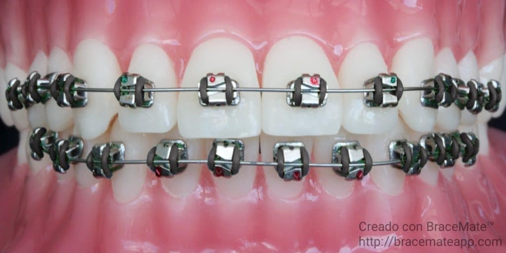 Ideas de colores de brackets negros